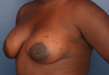 After Image: Breast Augmentation with Lift - left-front-oblique