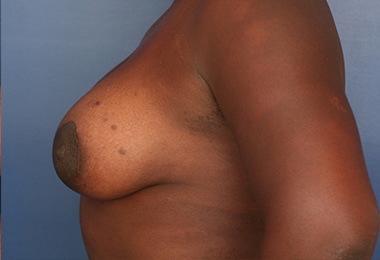 After Image: Breast Augmentation with Lift - left-side