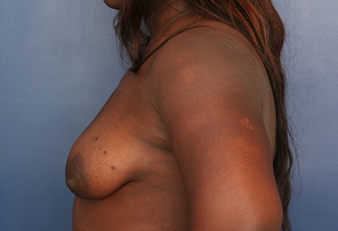 Before Image: Breast Augmentation with Lift - left-side