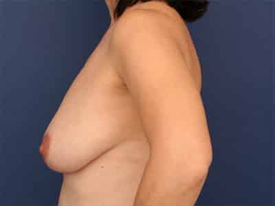 Before Image: Breast Augmentation with Lift - left-side