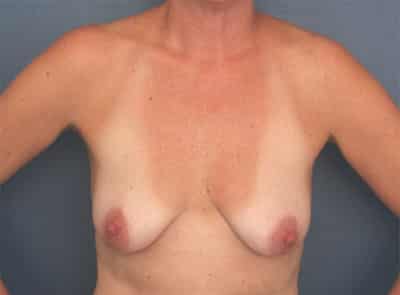 Before Image: Breast Augmentation with Lift - front