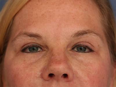 After Image: Botox - front