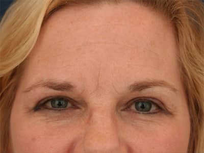 Before Image: Botox - front