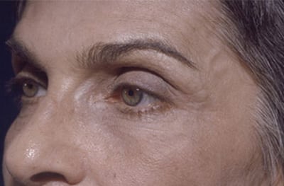 After Image: Botox - left-front-oblique
