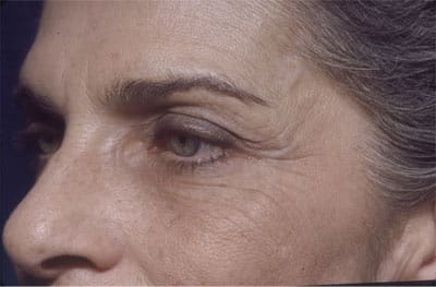 Before Image: Botox - left-front-oblique