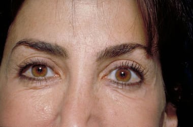 After Image: Botox - front