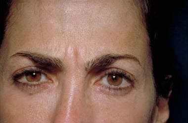 Before Image: Botox - front