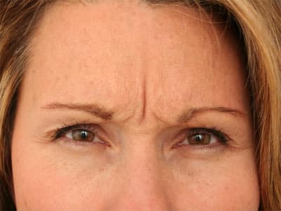 Before Image: Botox - front