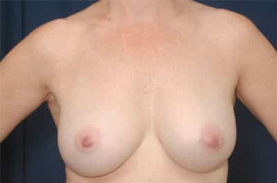 After Image: Breast Augmentation - front