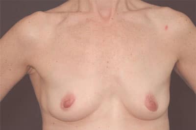 Before Image: Breast Augmentation - front