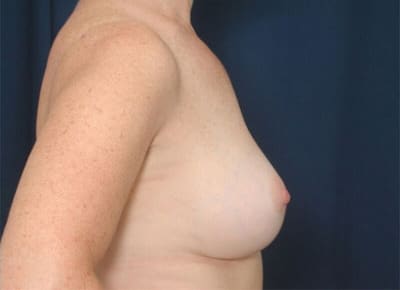 After Image: Breast Augmentation - right-side