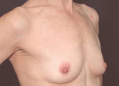 Before Image: Breast Augmentation - right-front-oblique