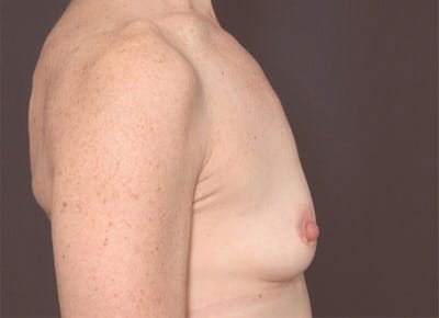 Before Image: Breast Augmentation - right-side