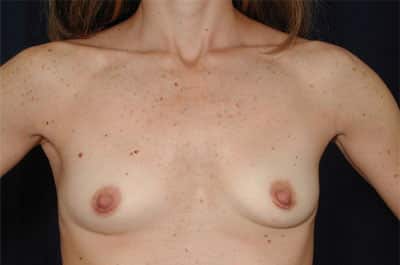 Before Image: Breast Augmentation - front