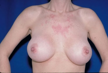 After Image: Breast Augmentation - front