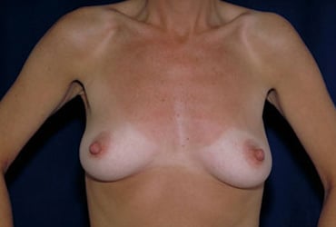Before Image: Breast Augmentation - front