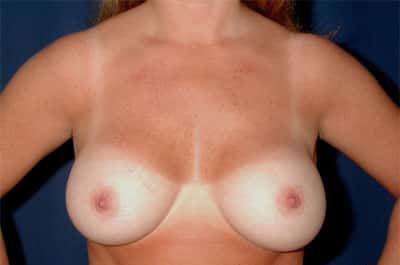 After Image: Breast Augmentation - front