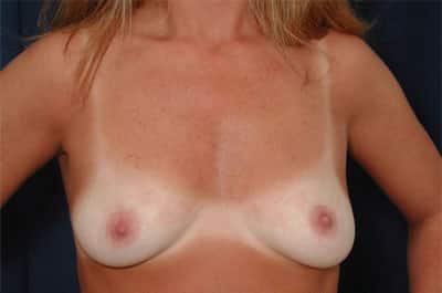 Before Image: Breast Augmentation - front