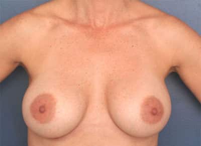 After Image: Breast Augmentation - front