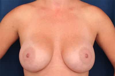 After Image: Breast Augmentation - front