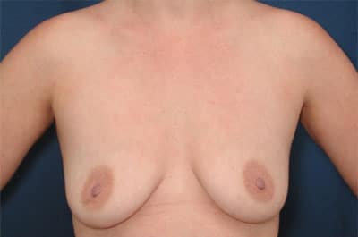 Before Image: Breast Augmentation - front