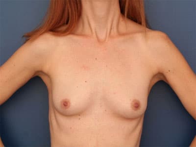 Before Image: Breast Augmentation - front