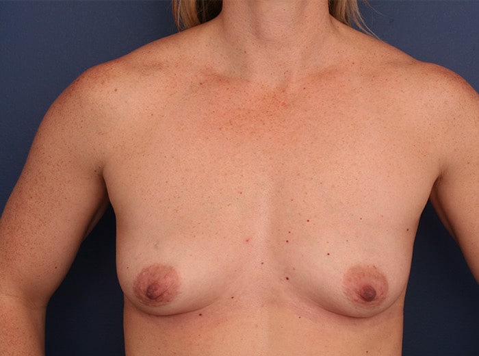 Before Image: Breast Augmentation - front