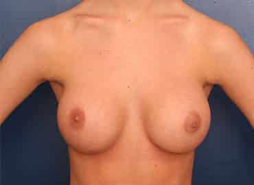 After Image: Breast Augmentation - front