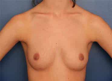 Before Image: Breast Augmentation - front