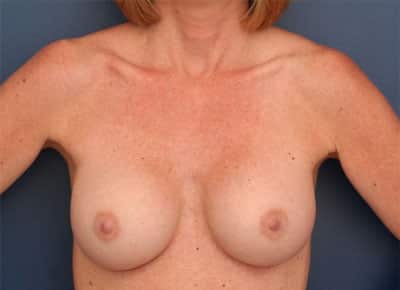 After Image: Breast Augmentation - front