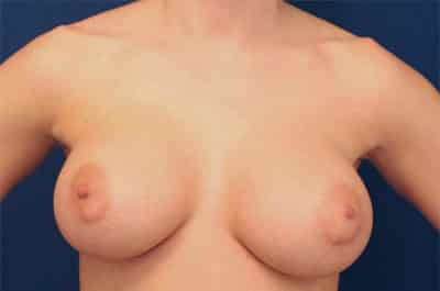 After Image: Breast Augmentation - front