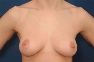 Before Image: Breast Augmentation - front