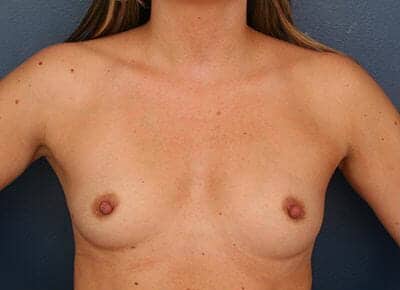 Before Image: Breast Augmentation - front
