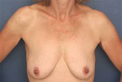 Before Image: Breast Augmentation with Lift - front