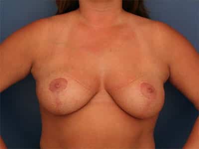 After Image: Breast Lift - front