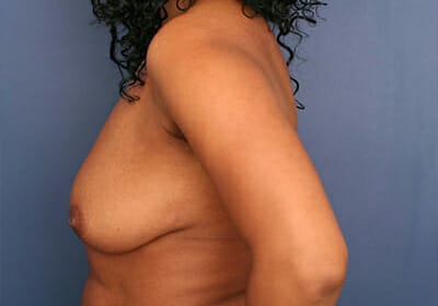 Before Image: Breast Lift - left-side