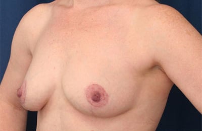 After Image: Breast Lift - left-front-oblique