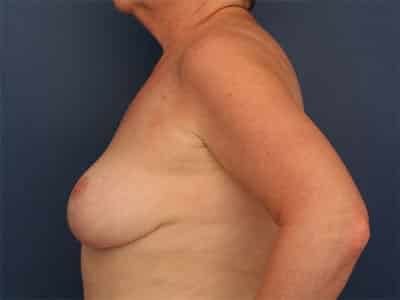 After Image: Breast Lift - left-side