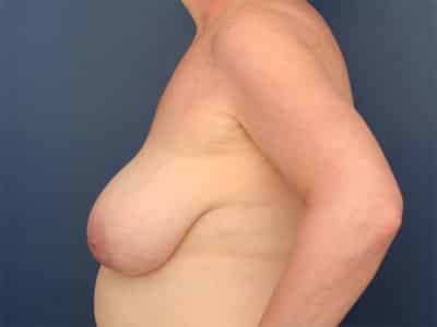Before Image: Breast Lift - left-side