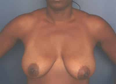 Before Image: Breast Lift - front