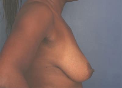 Before Image: Breast Lift - right-side