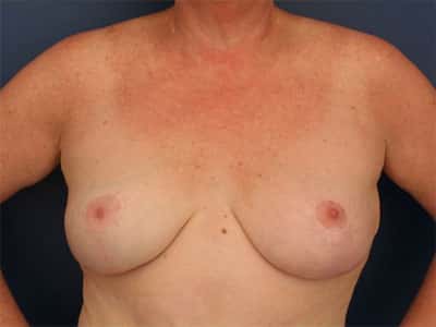 After Image: Breast Lift - front