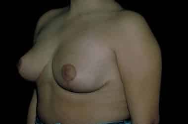After Image: Breast Reduction - left-front-oblique