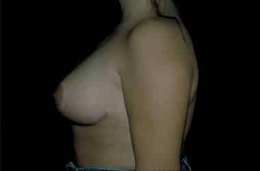 After Image: Breast Reduction - left-side