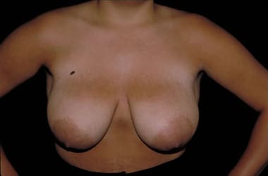 Before Image: Breast Reduction - front