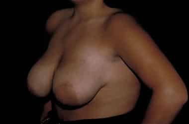 Before Image: Breast Reduction - left-front-oblique