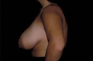 Before Image: Breast Reduction - left-side