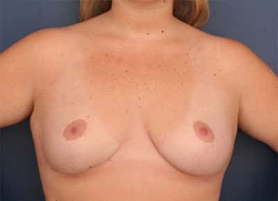 After Image: Breast Reduction - front