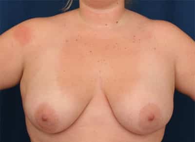 Before Image: Breast Reduction - front