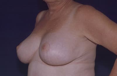 After Image: Breast Reduction - left-front-oblique